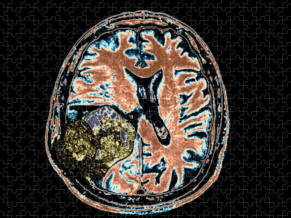 Mri Jigsaw Puzzle featuring the photograph Mr Of Malignant Brain Tumor 2 Of 3 by Living Art Enterprises