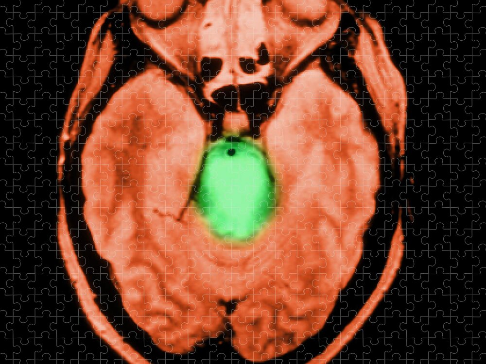 Abnormal Brainstem Jigsaw Puzzle featuring the photograph Mri Of Brainstem Glioma #2 by Medical Body Scans