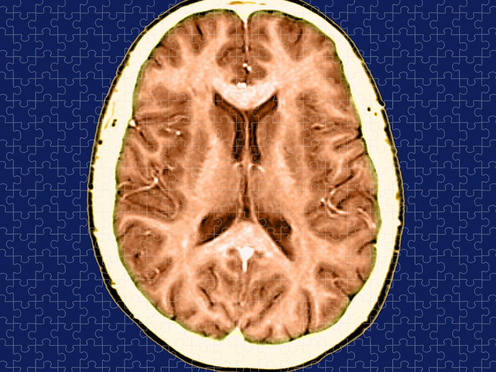 Anatomical Jigsaw Puzzle featuring the photograph Normal Cross Sectional Mri Of The Brain #2 by Medical Body Scans