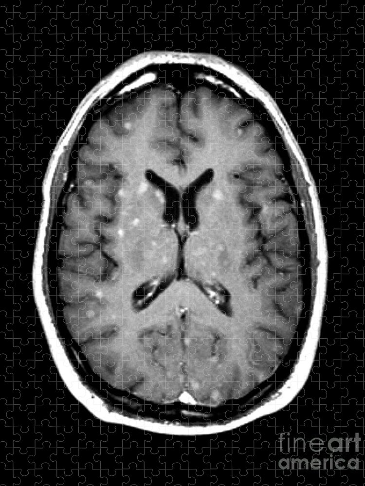 Medical Image Jigsaw Puzzle featuring the photograph Abnormal Mri Of Brain #3 by Medical Body Scans