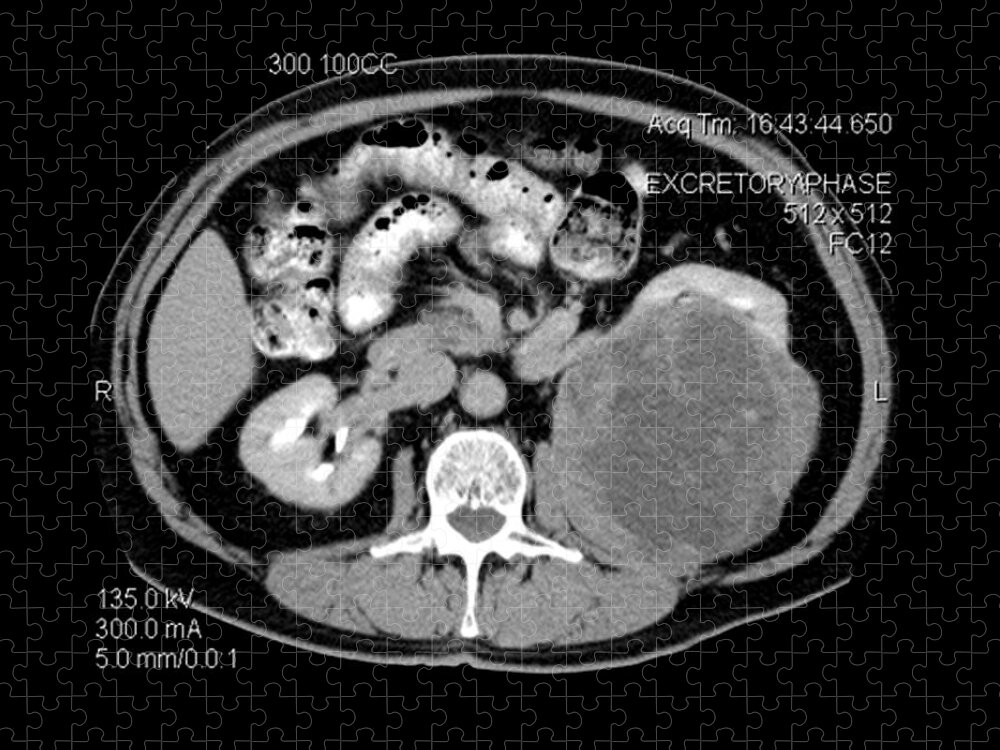 Ct Of Abdomen Jigsaw Puzzle featuring the photograph Ct Of Abdomen, Large Renal Carcinoma #3 by Medical Body Scans