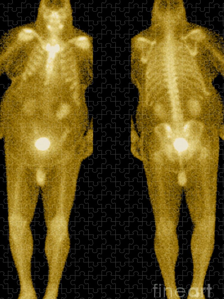 Obese Jigsaw Puzzle featuring the photograph Bone Scan by Medical Body Scans