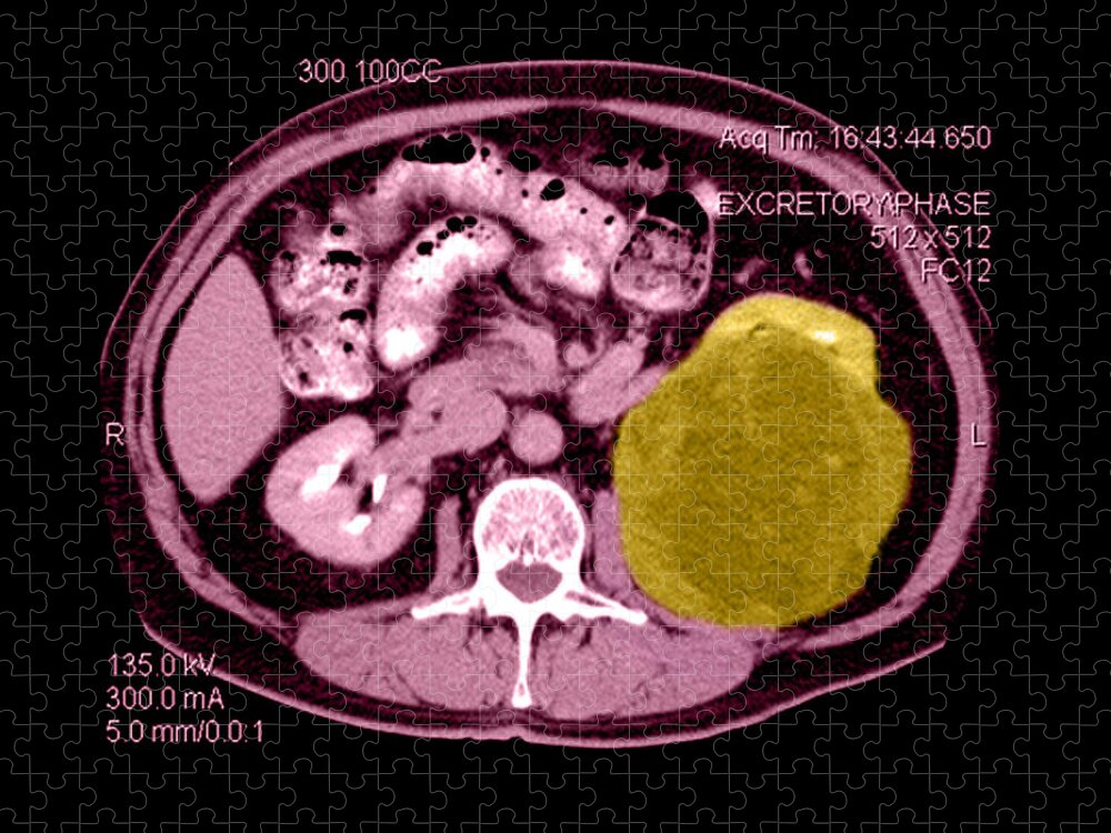 Abnormal Ct Of Abdomen Jigsaw Puzzle featuring the photograph Ct Of Abdomen, Large Renal Carcinoma by Medical Body Scans