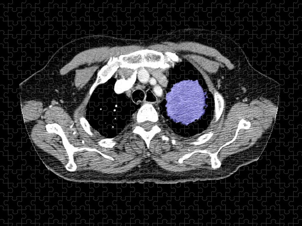 Spiral Ct Chest Jigsaw Puzzle featuring the photograph Lung Cancer by Medical Body Scans