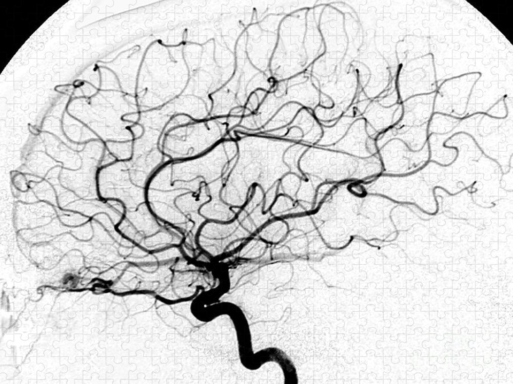 Cerebral Angiogram Jigsaw Puzzle featuring the photograph Dural Arterial Venous Fistula, Angiogram by Living Art Enterprises