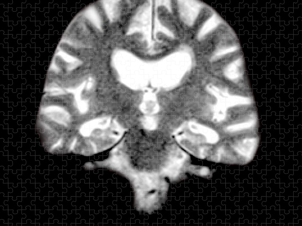 Magnetic Resonance Imaging Jigsaw Puzzle featuring the photograph Mri Of Brain With Alzheimers Disease by Medical Body Scans