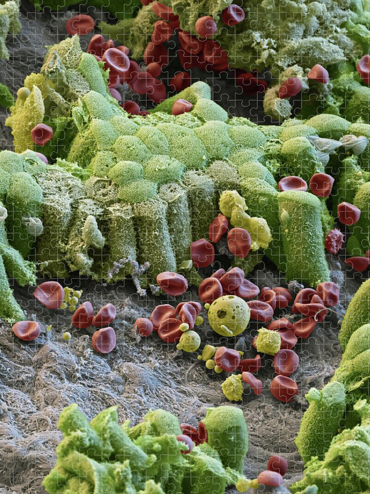 Abnormal Jigsaw Puzzle featuring the photograph Damaged Gallbladder, Sem #3 by Eye of Science