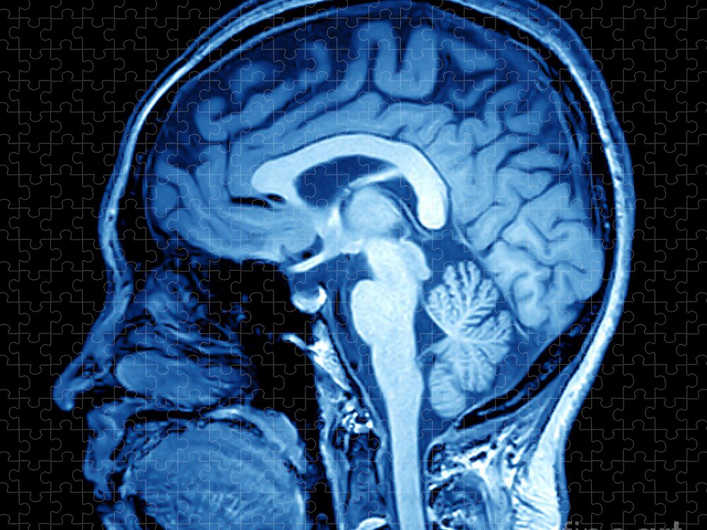 Aneurysm Jigsaw Puzzle featuring the photograph Magnetic Resonance Image Mri by Mriman