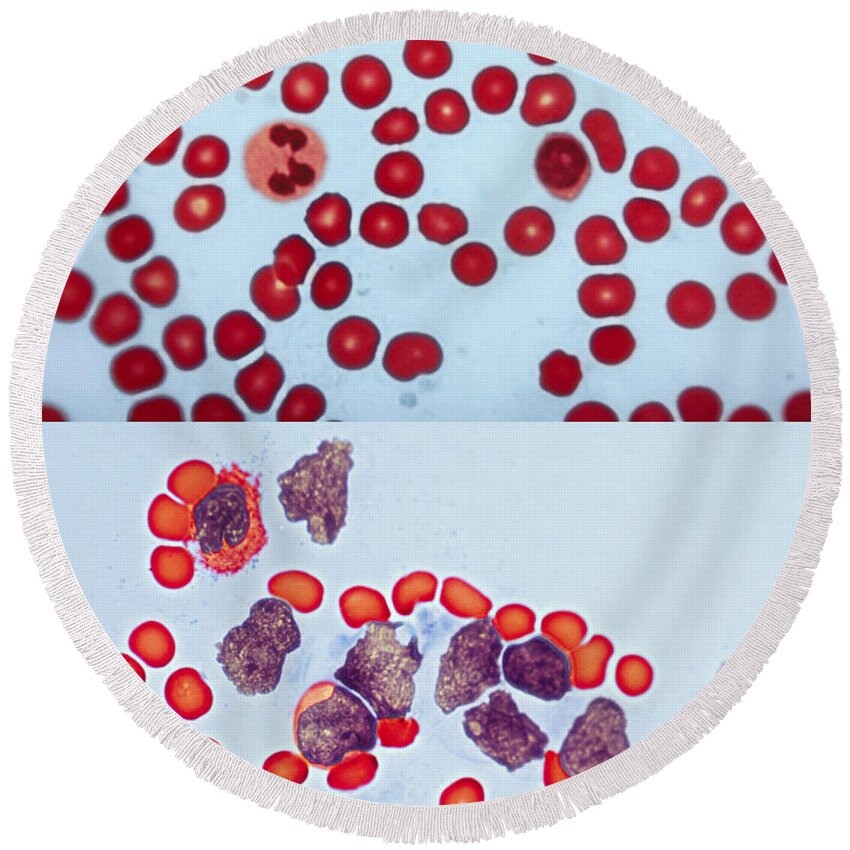 Blood Cell Round Beach Towel featuring the photograph Healthy Leukemia Blood Comparison by Spencer Sutton
