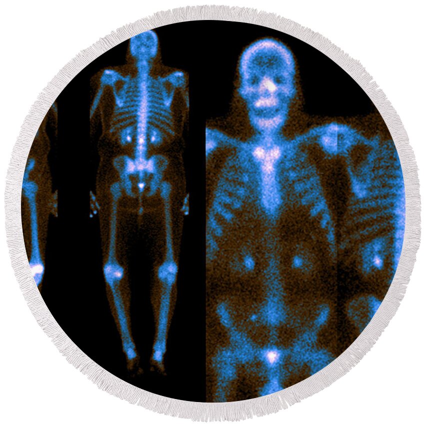 Bone Round Beach Towel featuring the photograph Bone Scans #1 by Medical Body Scans