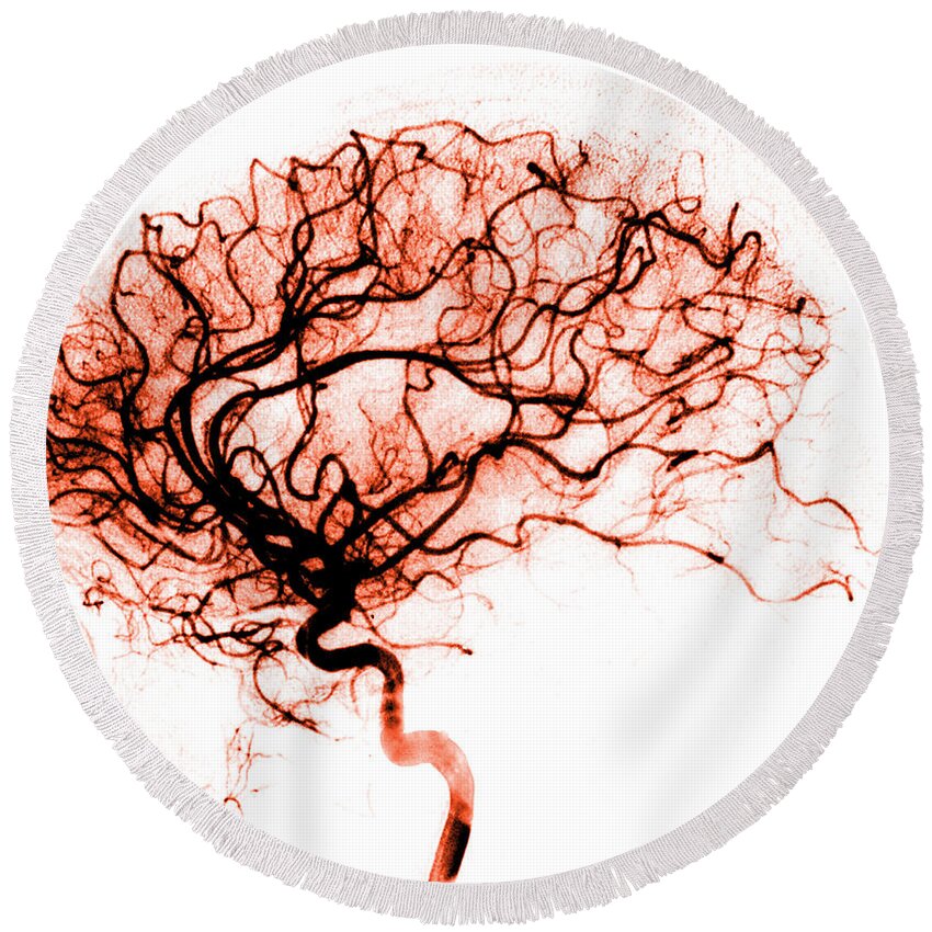 Catheter Cerebral Angiogram Round Beach Towel featuring the photograph Cerebral Angiogram by Medical Body Scans