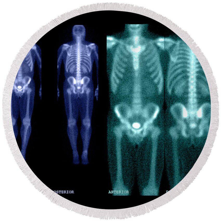 Nuclear Medicine Round Beach Towel featuring the photograph Bone Scan #7 by Medical Body Scans
