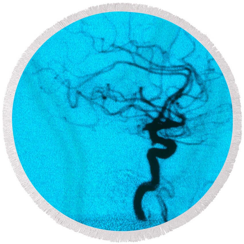 Angiogram Round Beach Towel featuring the photograph Cerebral Angiogram by Science Source