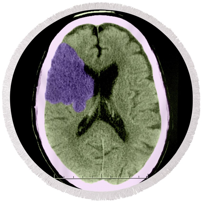 Ct Scan Round Beach Towel featuring the photograph Ct Of Stroke by Medical Body Scans