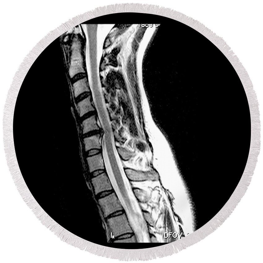Medical Round Beach Towel featuring the photograph Herniated Disc In Cervical Spine by Medical Body Scans