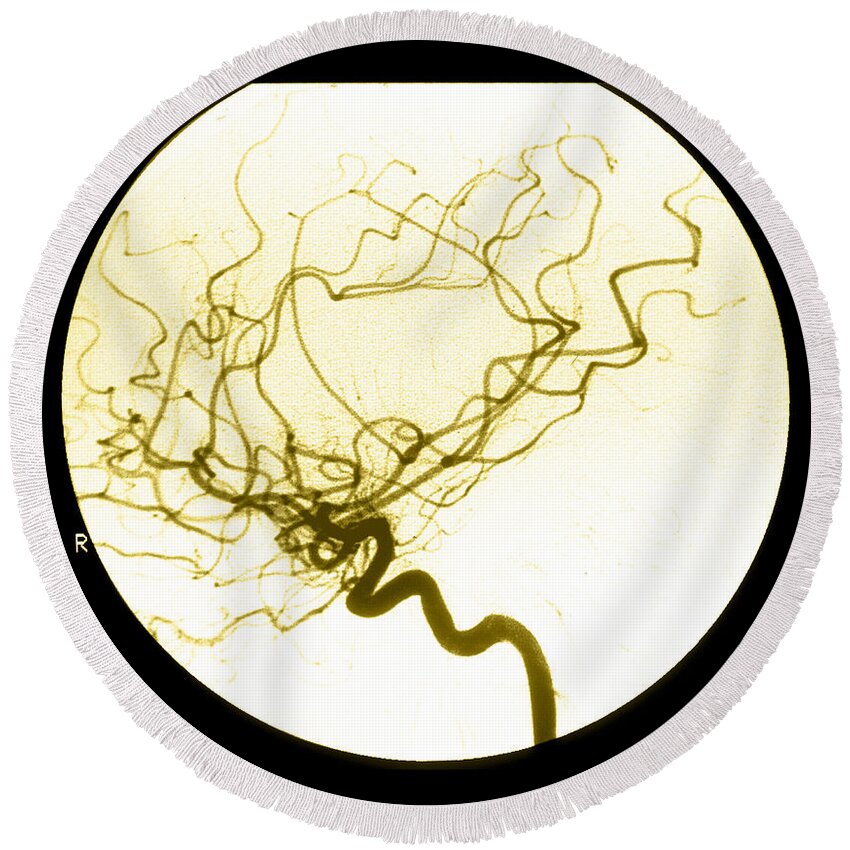 Cerebral Angiogram Round Beach Towel featuring the photograph Internal Carotid Cerebral Angiogram by Medical Body Scans