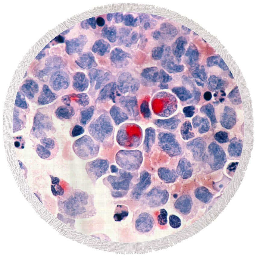 Myelocytic Leukemia Round Beach Towel featuring the photograph Myelocytic Leukemia by Science Source