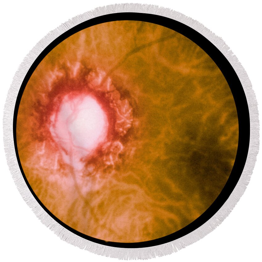 Bacteria Round Beach Towel featuring the photograph Retina Infected By Syphilis by Science Source