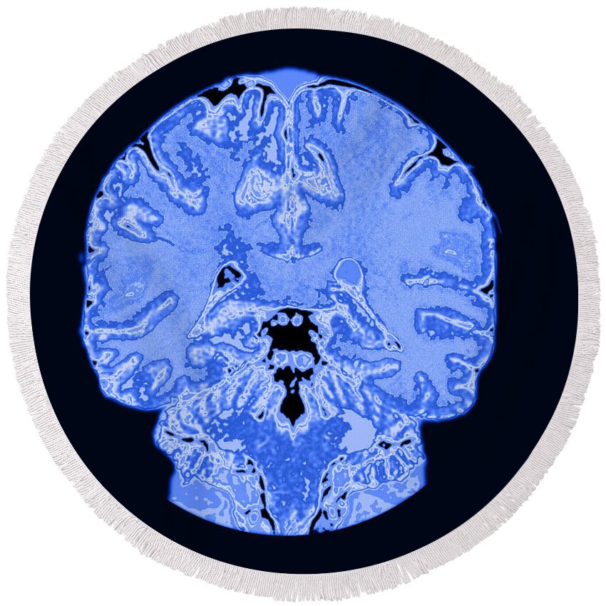 Brain Round Beach Towel featuring the photograph Coronal View Mri Of Normal Brain #2 by Medical Body Scans