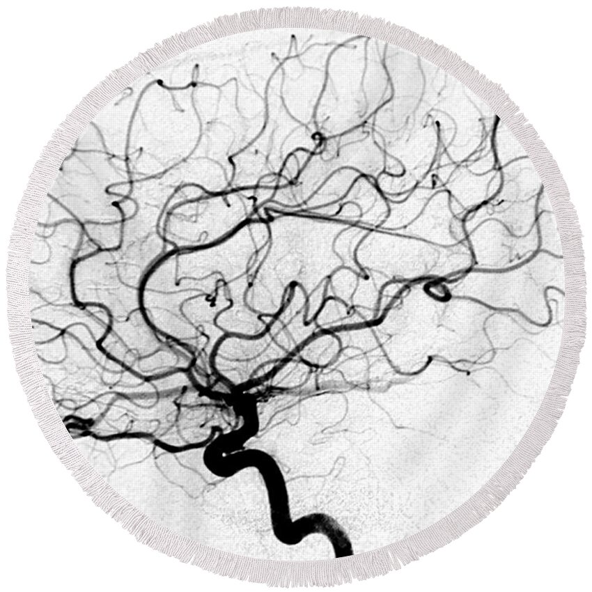 Cerebral Angiogram Round Beach Towel featuring the photograph Dural Arterial Venous Fistula, Angiogram by Living Art Enterprises