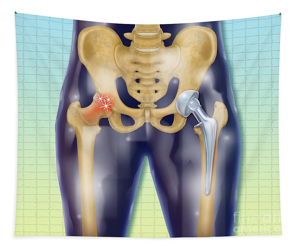 Science Tapestry featuring the photograph Arthritic And Replacement Hip #1 by Chris Bjornberg