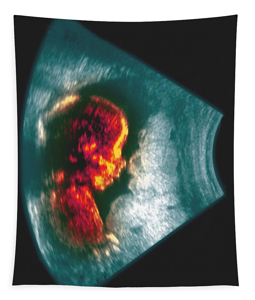 Birth Tapestry featuring the photograph Ultrasound Of A 5 Month Old Fetus #1 by Scott Camazine