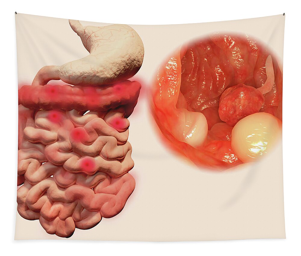 Abnormal Tapestry featuring the photograph Intestinal Polyps, Illustration #2 by Juan Gaertner