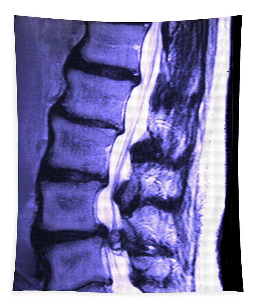 Aging Tapestry featuring the photograph Arthritic Spine #3 by Chris Bjornberg