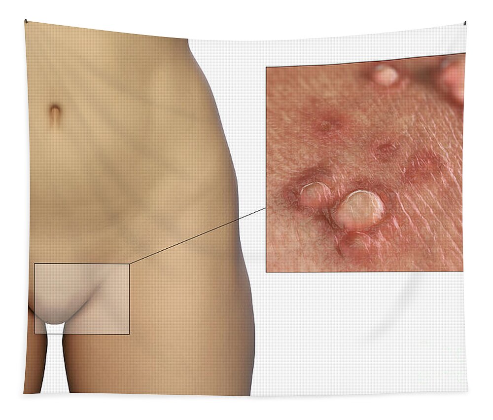 3d Visualisation Tapestry featuring the photograph Genital Warts #3 by Science Picture Co