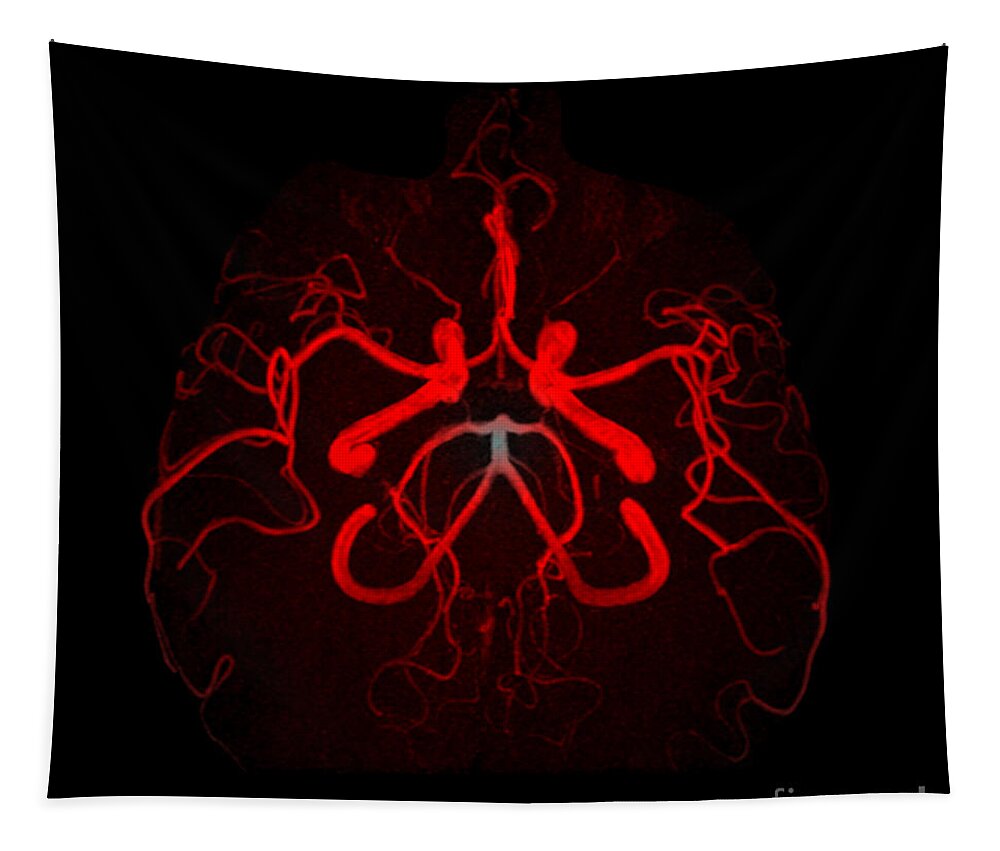Intracranial Mra Tapestry featuring the photograph Normal Intracranial Mra #4 by Living Art Enterprises