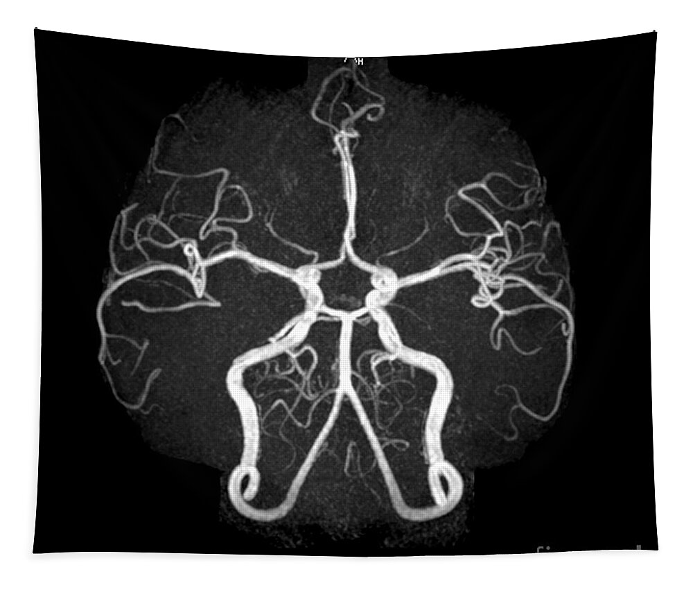 Magnetic Resonance Angiography Tapestry featuring the photograph Normal Intracranial Mra #6 by Living Art Enterprises