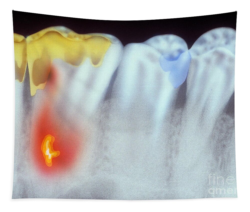 Teeth Tapestry featuring the photograph Dental X-ray by Chris Bjornberg