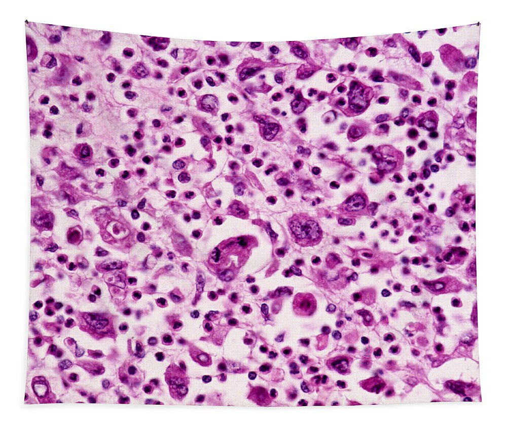 Abnormal Tapestry featuring the photograph Giant-cell Carcinoma Of The Lung, Lm by Michael Abbey