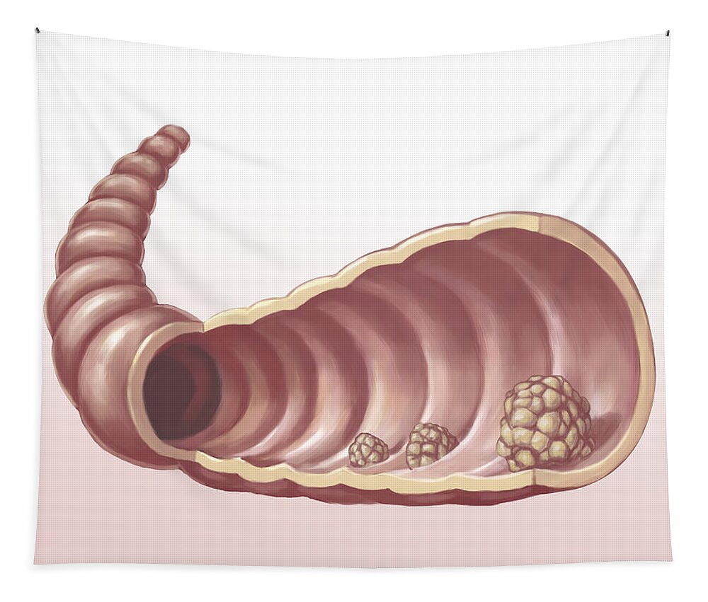 Digestive System Tapestry featuring the photograph Intestinal Polyps, Illustration by Spencer Sutton
