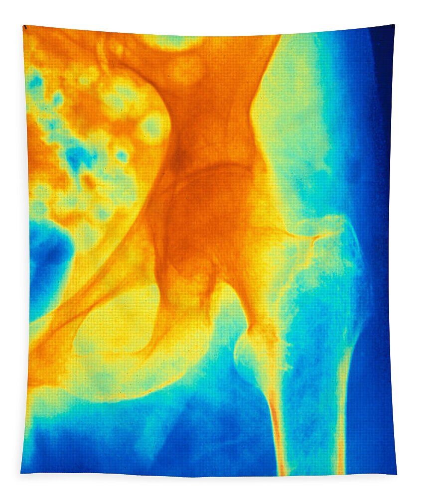 Medical Tapestry featuring the photograph Osteoporosis Of The Hip, X-ray by Scott Camazine