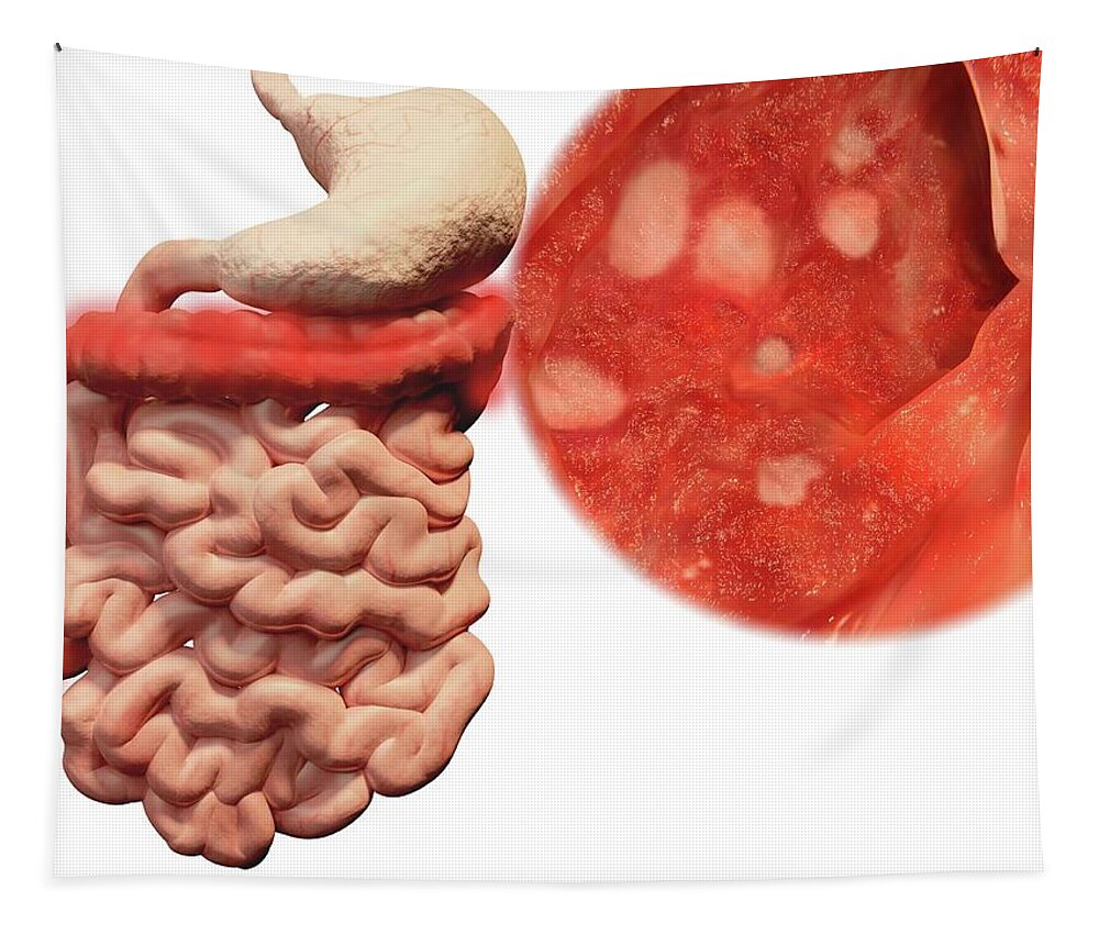 Abnormal Tapestry featuring the photograph Ulcerative Colitis, Illustration by Juan Gaertner