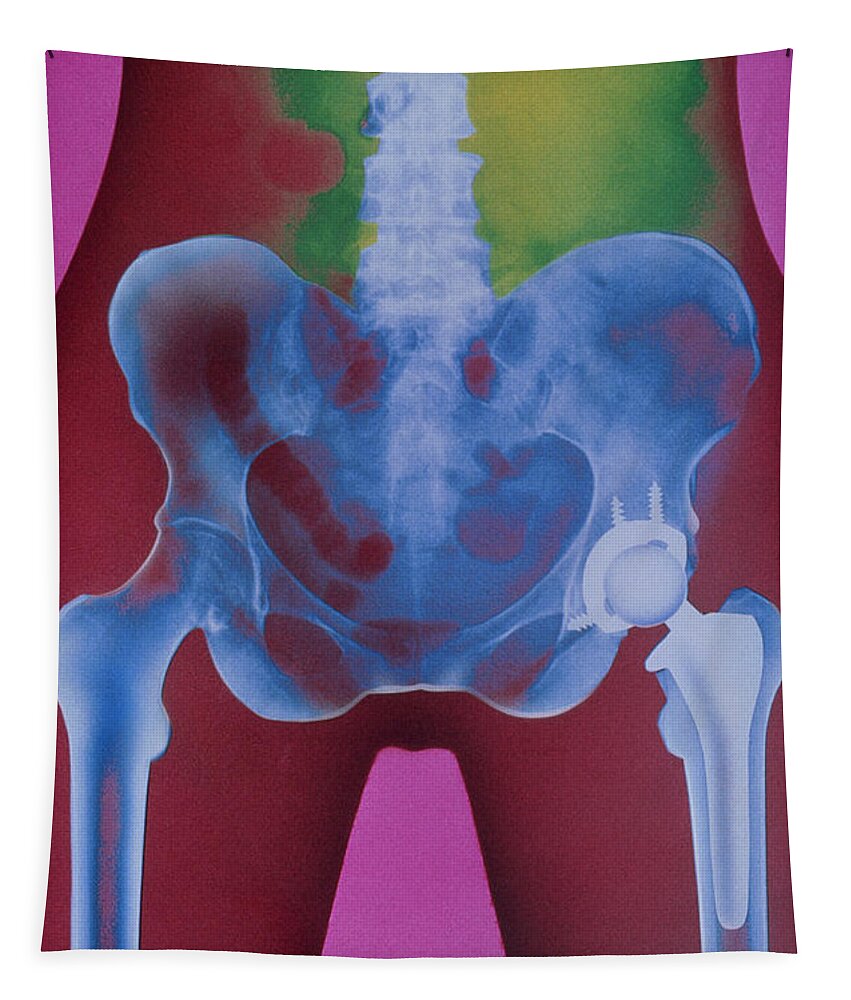 X-ray Of Prosthetic Hip Tapestry featuring the photograph X-ray Of Prosthetic Hip by Chris Bjornberg