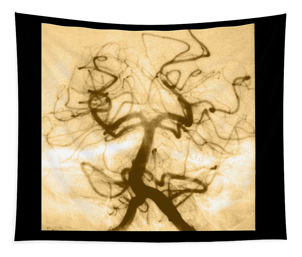 Abnormal Cerebral Angiogram Tapestry featuring the photograph Angiogram Of Embolus In Cerebral Artery #1 by Medical Body Scans