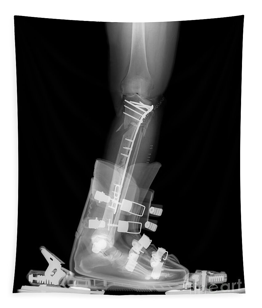 X-ray Tapestry featuring the photograph X-ray Of Broken Bones In Ski Boot #2 by Ted Kinsman