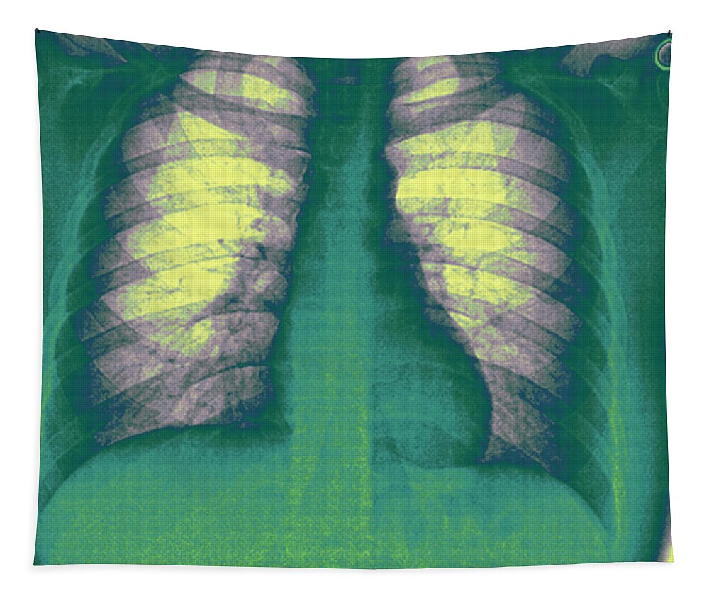Chest X-ray - Copd And Scoliosis Throw Pillow by Medical Body Scans - Fine  Art America