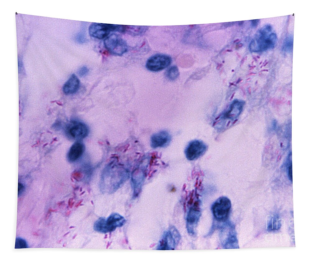Science Tapestry featuring the photograph Mycobacterial Skin Infection #3 by Science Source