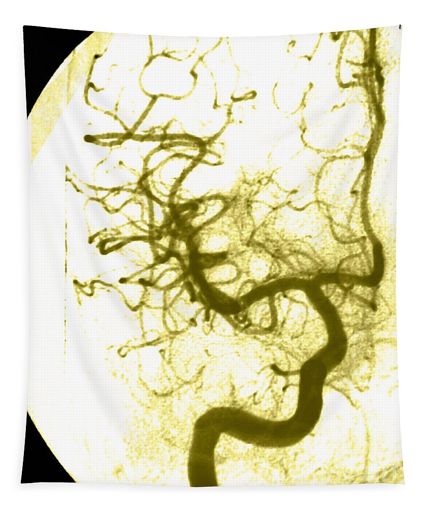 Angiogram Tapestry featuring the photograph Cerebral Angiogram #7 by Medical Body Scans