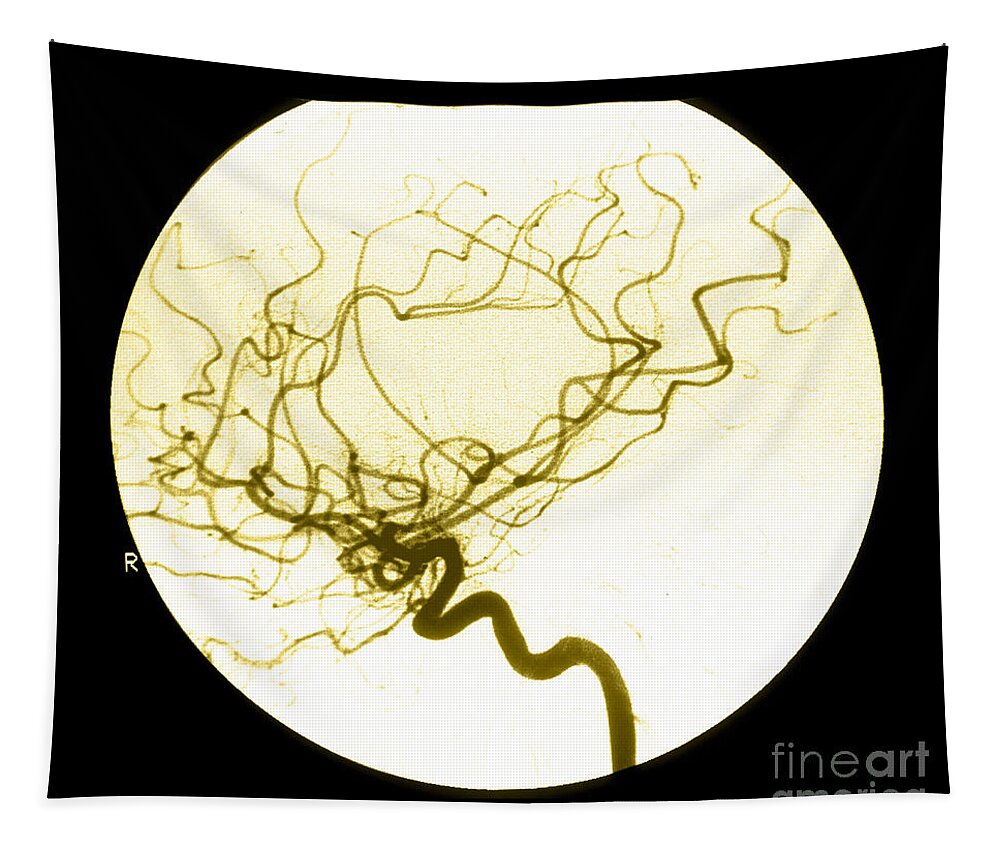 Cerebral Angiogram Tapestry featuring the photograph Internal Carotid Cerebral Angiogram by Medical Body Scans