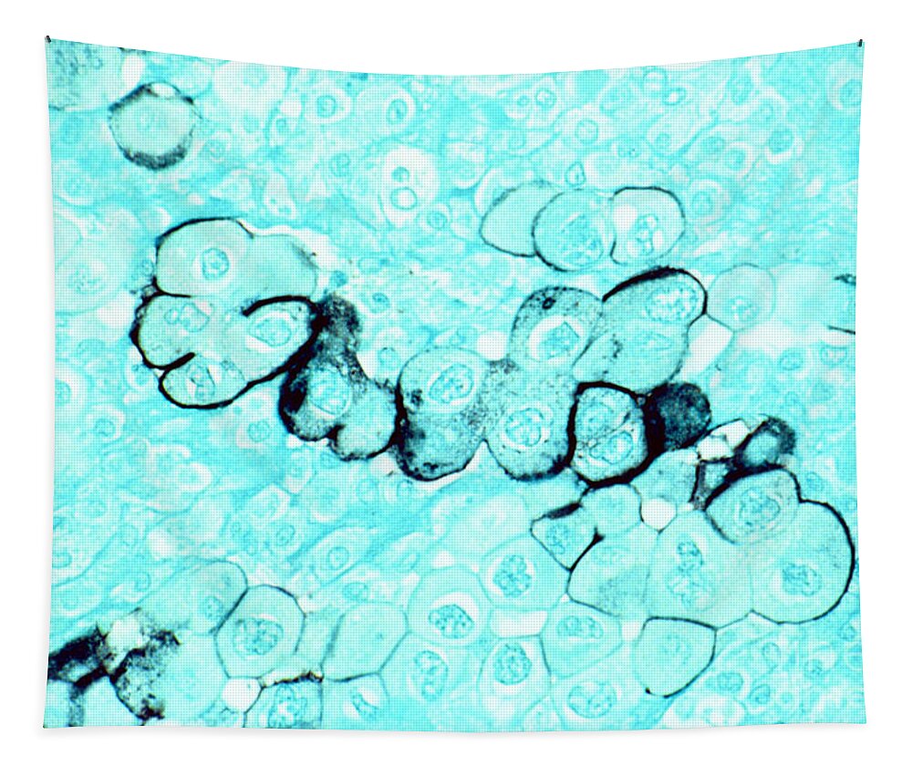 Pancreatic Cancer Tapestry featuring the photograph Pancreatic Cancer Cells by Science Source