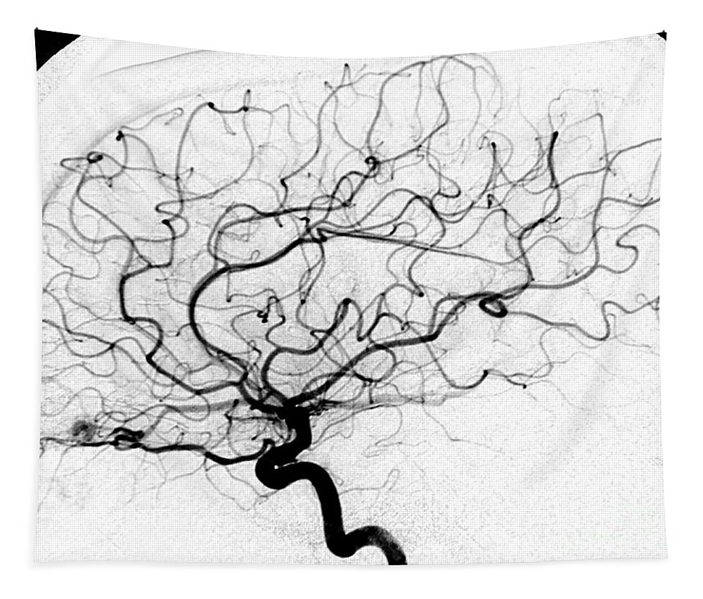 Cerebral Angiogram Tapestry featuring the photograph Dural Arterial Venous Fistula, Angiogram by Living Art Enterprises