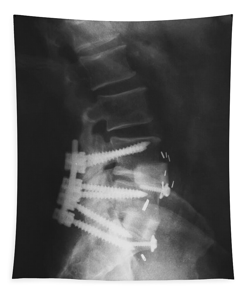Lumbar Spinal Fusion Tapestry featuring the photograph Lumbar Spinal Fusion by Olga Hamilton