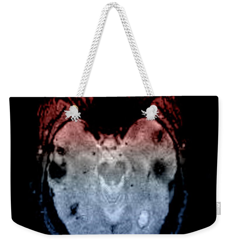Mri Weekender Tote Bag featuring the photograph Mri Of Amyloid Angiopathy #1 by Living Art Enterprises