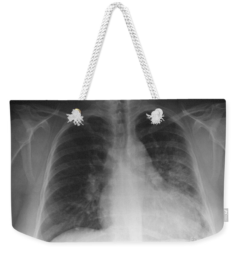 X Ray Weekender Tote Bag featuring the photograph Pneumonia, X Ray #1 by Scott Camazine