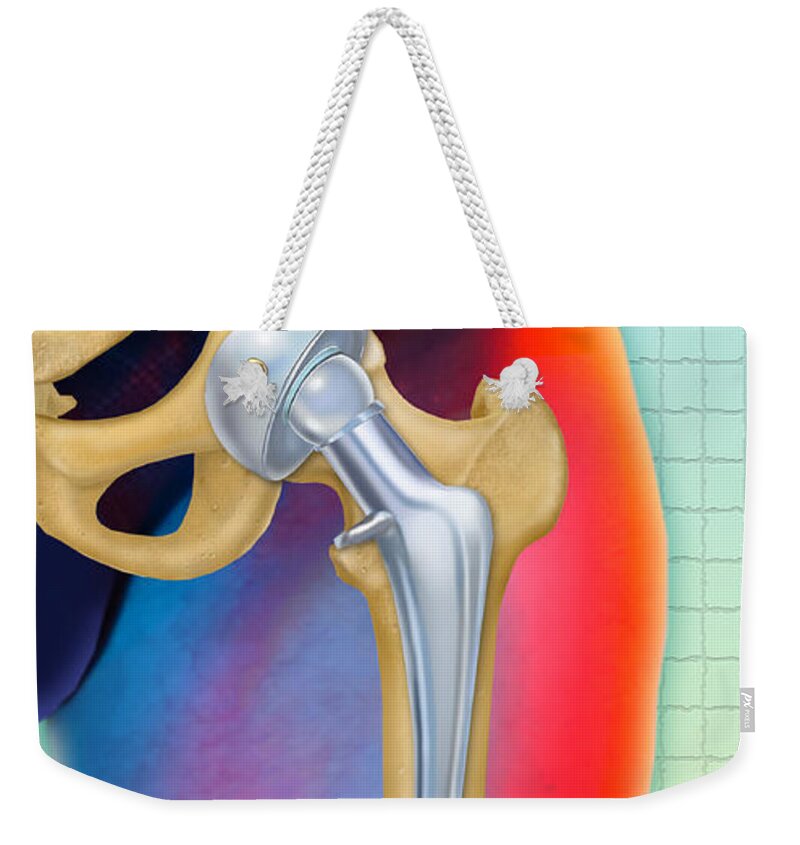 Art Weekender Tote Bag featuring the photograph Prosthetic Hip Replacement by Chris Bjornberg