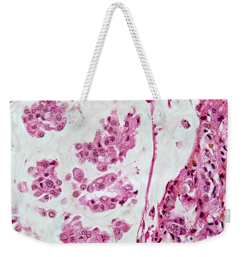 Micrograph Weekender Tote Bag featuring the photograph Colloid Liver Tumor, Lm #2 by Garry DeLong